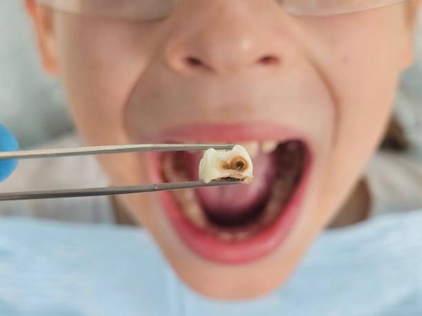 Best Emergency Dentist for Knocked-Out Tooth in Governors Village, NC